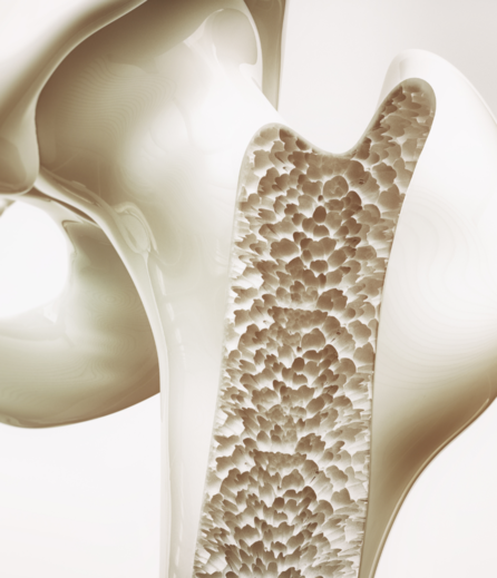 Osteoporosis and fragility fractures