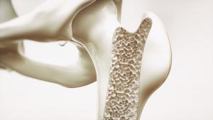 Osteoporosis is a silent epidemic