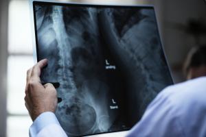 Spinal fractures detected by Articifial Intelligence