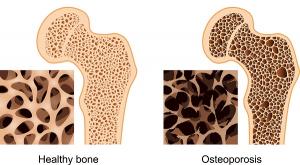 Picture of a healthy bone and one with osteoporosis